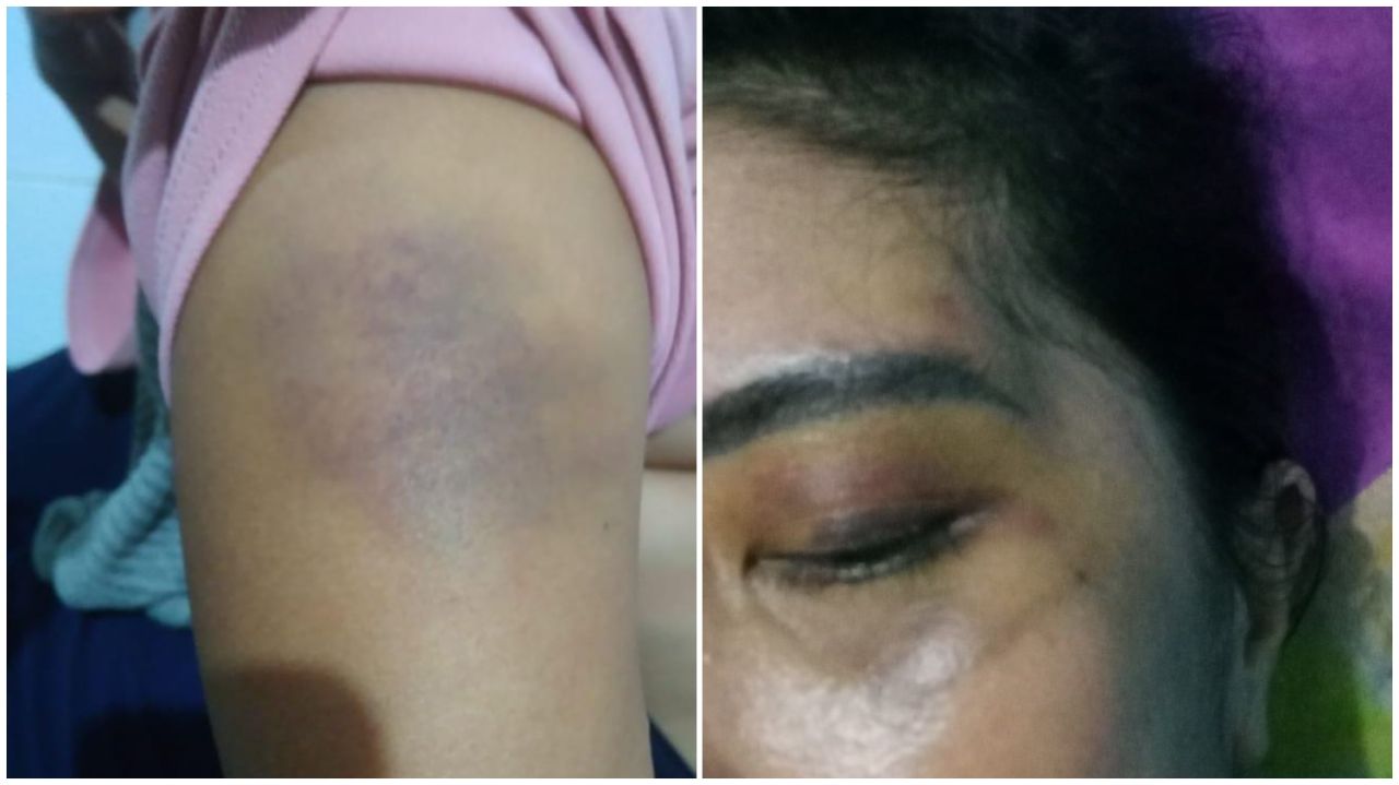 Luka lebam di wajah dan lengan Komariyah